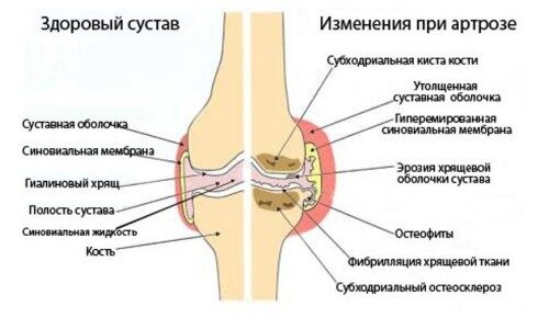 Как лечить посттравматический артроз?