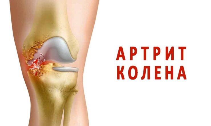 Симптомы и лечение ревматоидного артрита коленного сустава