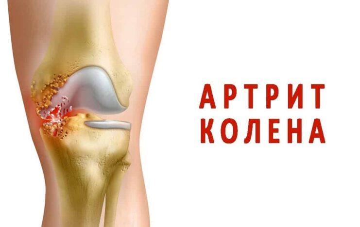 Симптомы и лечение ревматоидного артрита коленного сустава
