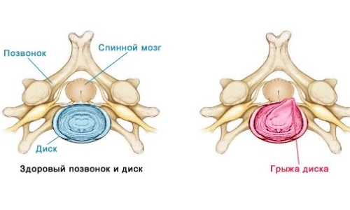 Схема грыжи позвоночника