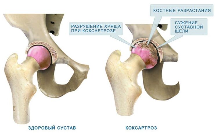 Коксартроз: причины и лечение народными средствами