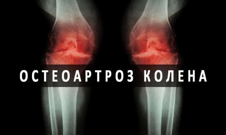Признаки и лечение остеопороза коленного сустава 1 степени
