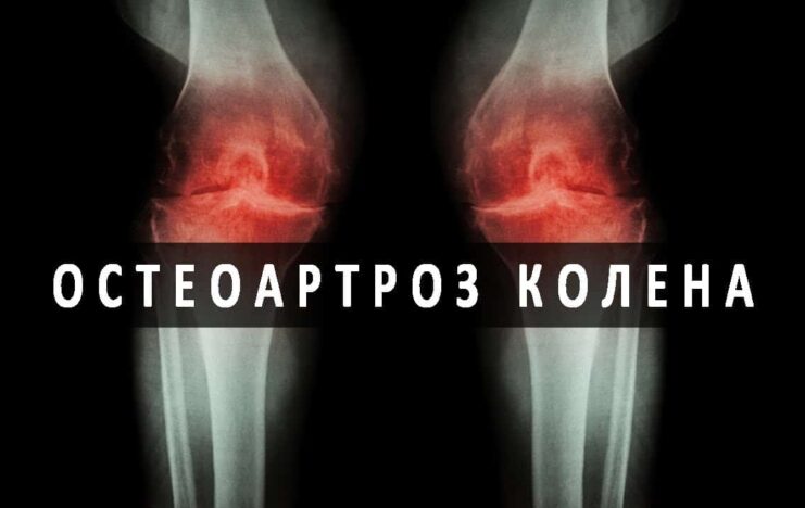 Признаки и лечение остеопороза коленного сустава 1 степени