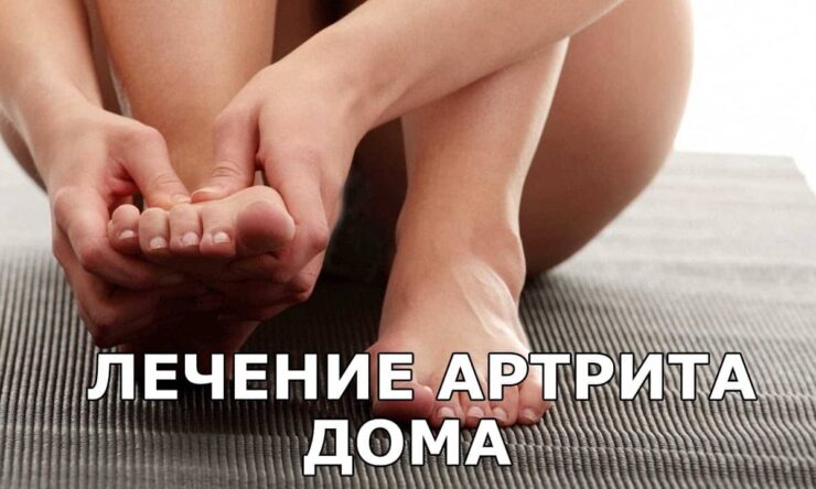 Особенности лечения артрита в домашних условиях