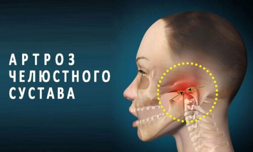 Симптомы и лечение артроза челюстного сустава