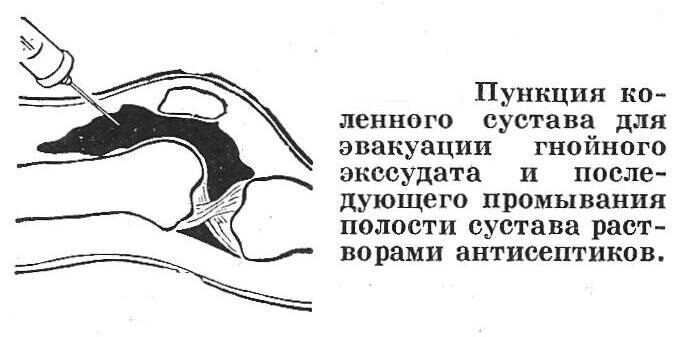 Причины, симптомы, виды и лечение бурсита коленного сустава