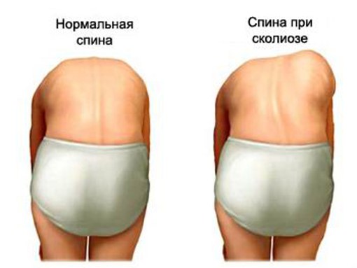 Определение искривления позвоночника
